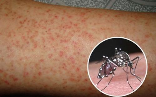 Đắk Lắk ghi nhận một trường hợp tử vong do sốt xuất huyết