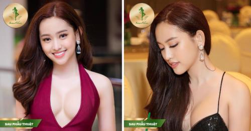 Giải pháp giúp mũi đẹp hơn với công nghệ Sform, Sform Plus tại Sài Gòn Venus