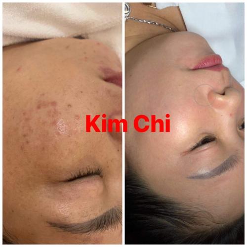 GIẢI PHÁP ĐIỀU TRỊ CĂN BỆNH NÁM DA TỪ CHIA SẺ CỦA NỮ GIÁM ĐỐC SPA KIM CHI